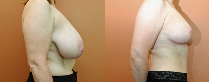 Breast Reduction — Side View