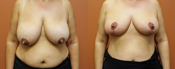 Breast Reduction — Angle View