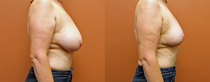 Breast Reduction — Side View