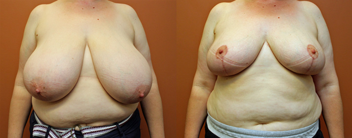 Breast Reduction — Front View