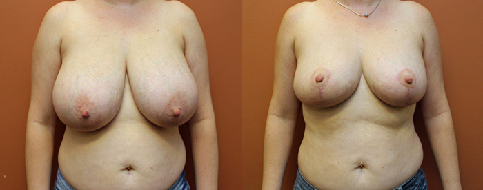 Breast Reduction Patient 1 — Front View
