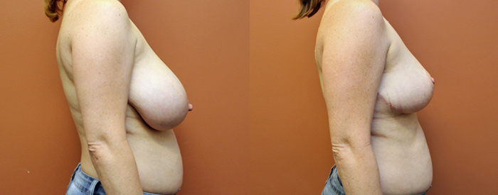 Breast Reduction Patient 1 — Side View