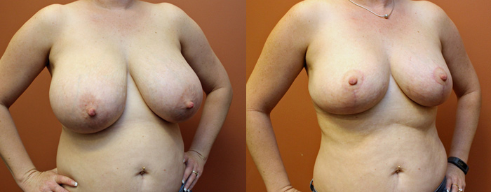Breast Reduction Patient 1 — Angle View