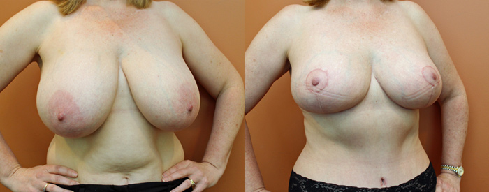Breast Reduction Patient 2 — Angle View