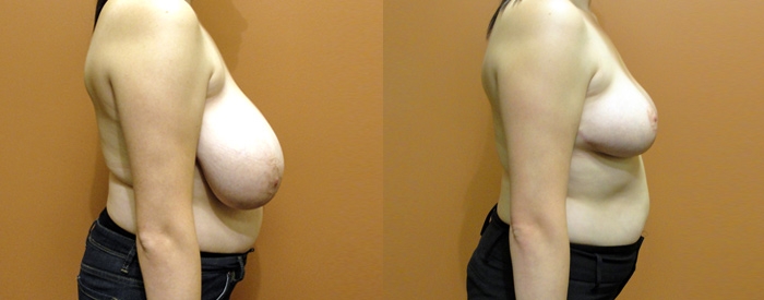 Breast Reduction Patient 2 — Side View