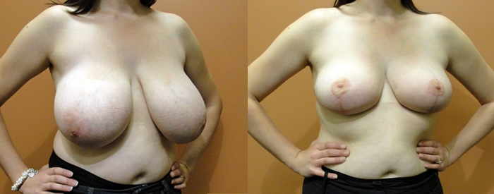 Breast Reduction Patient 2 — Angle View