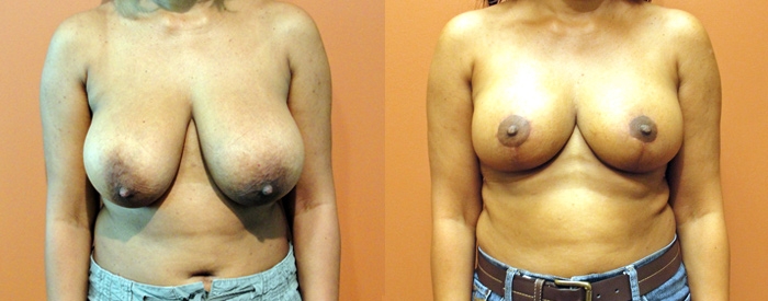 Breast Reduction Patient 3 — Front View