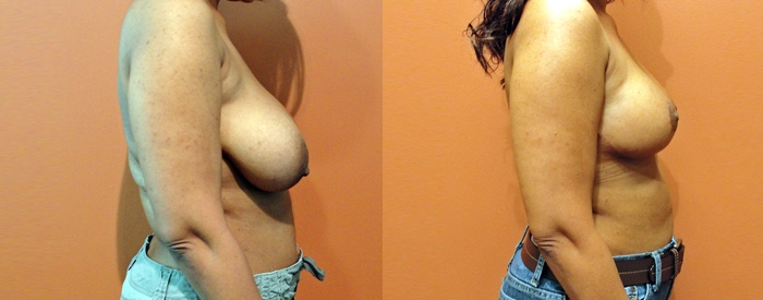 Breast Reduction Patient 3 — Side View