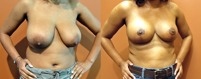 Breast Reduction Patient 3 — Angle View