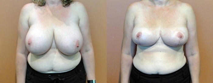 Breast Reduction Patient 4 — Front View
