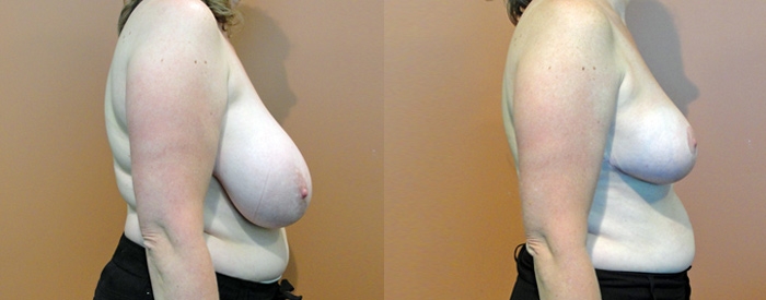 Breast Reduction Patient 4 — Side View