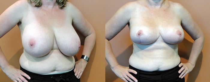 Breast Reduction Patient 4 — Angle View