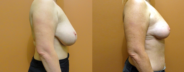 Breast Reduction Patient 5 — Side View