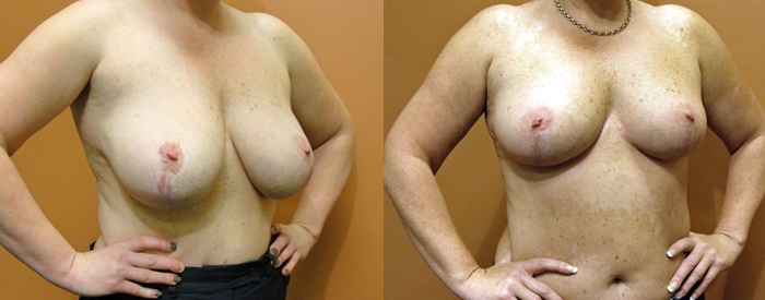 Breast Reduction Patient 5 — Angle View