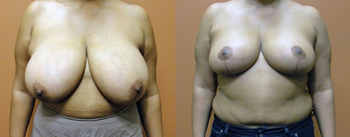 Breast Reduction Patient 8 — Front View