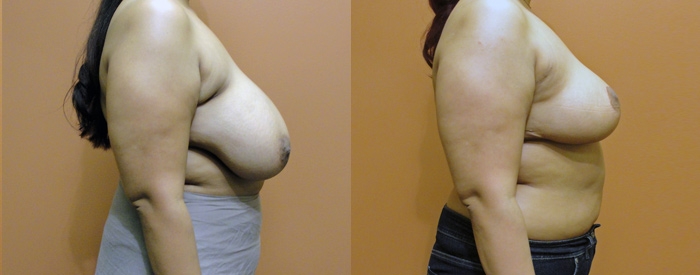 Breast Reduction Patient 8 — Side View