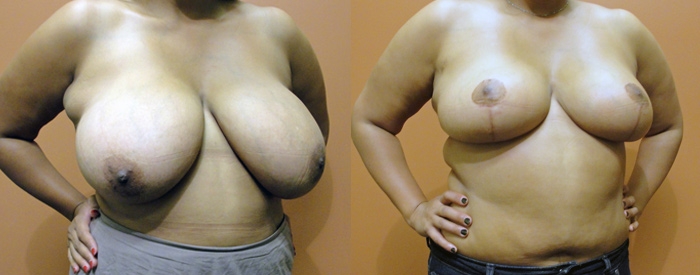 Breast Reduction Patient 8 — Angle View