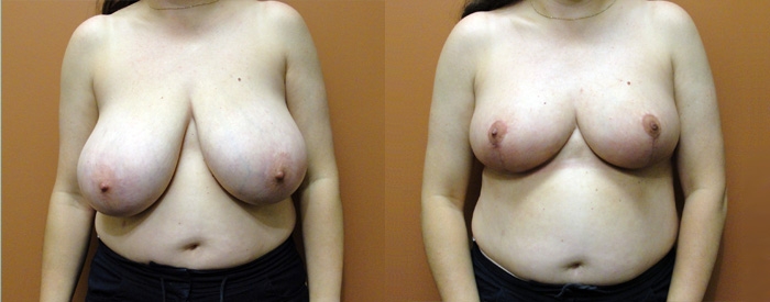 Breast Reduction Patient 9 — Front View