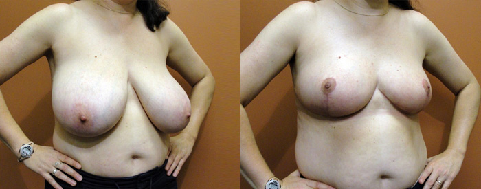 Breast Reduction Patient 9 — Angle View