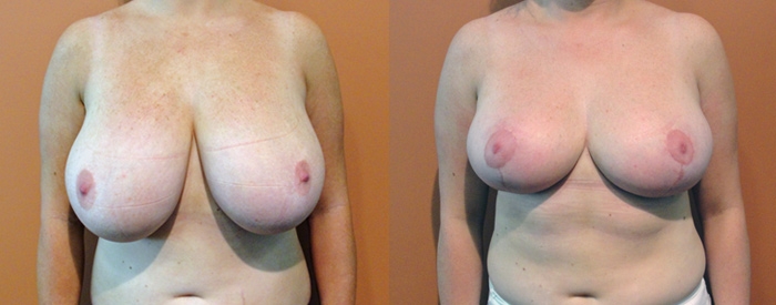 Breast Reduction Patient 10 — Front View