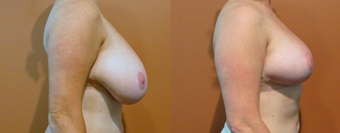 Breast Reduction Patient 10 — Side View