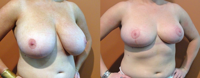 Breast Reduction Patient 10 — Angle View