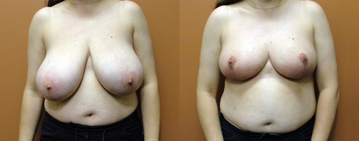 Breast Reduction Patient 11 — Front View