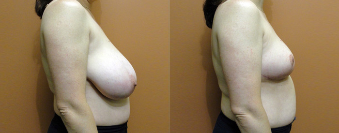 Breast Reduction Patient 11 — Side View