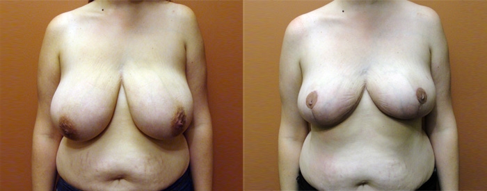 Breast Reduction Patient 12 — Front View