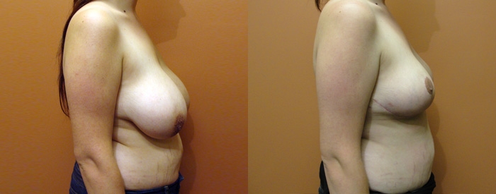 Breast Reduction Patient 12 — Side View
