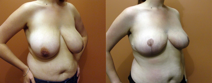 Breast Reduction Patient 12 — Angle View