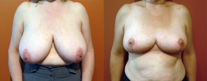Breast Reduction Patient 13 — Front View