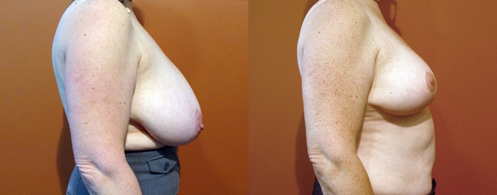 Breast Reduction Patient 13 — Side View