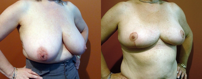 Breast Reduction Patient 13 — Angle View