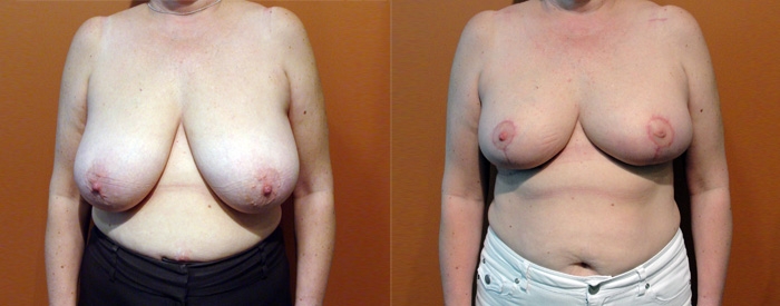 Breast Reduction Patient 14 — Front View