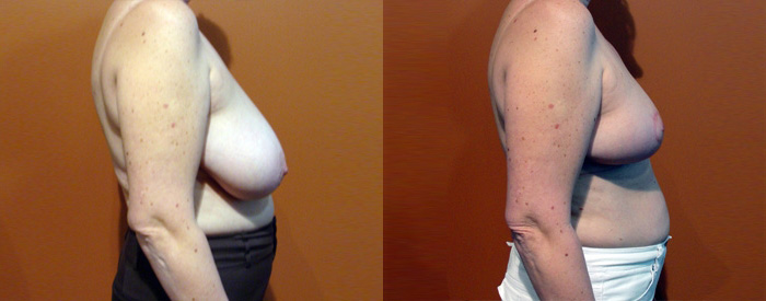 Breast Reduction Patient 14 — Side View