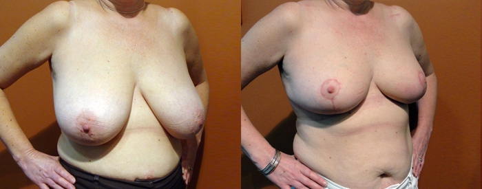 Breast Reduction Patient 14 — Angle View