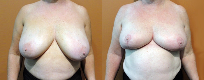 Breast Reduction Patient 15 — Front View
