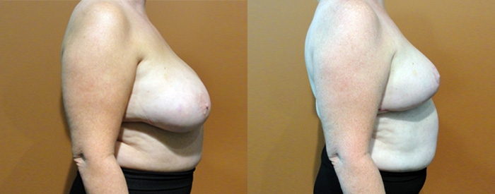 Breast Reduction Patient 15 — Side View