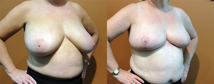 Breast Reduction Patient 15 — Angle View