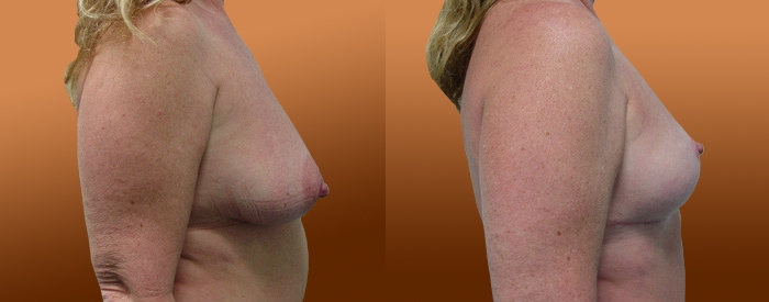 Breast Reduction Patient 17 — Side View