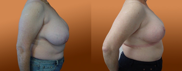 Breast Reduction Patient 18 — Side View