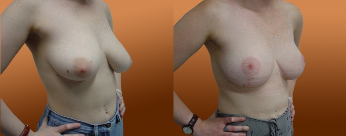 Breast Reduction Patient 19 — Side View