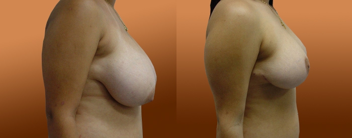 Breast Reduction Patient 21 — Side View