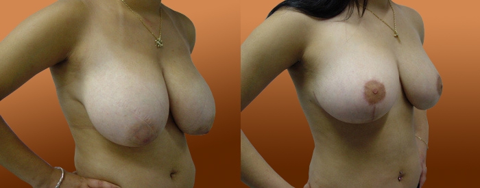Breast Reduction Patient 21 — Angle View