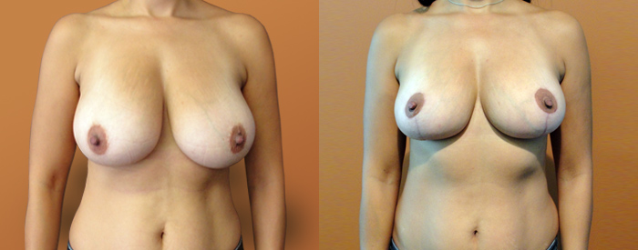 Breast Reduction Patient 22 — Front View