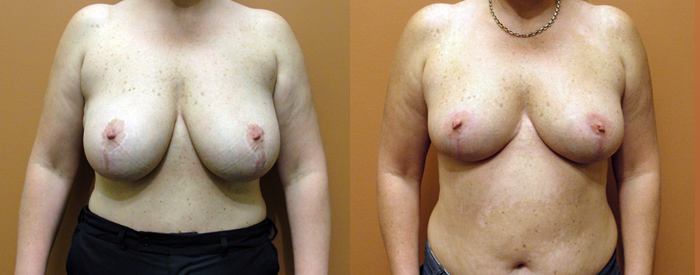 Breast Reduction Patient 23 — Front View