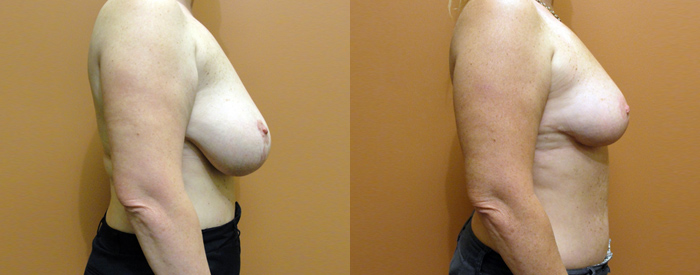 Breast Reduction Patient 23 — Side View