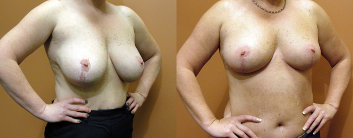Breast Reduction Patient 23 — Angle View