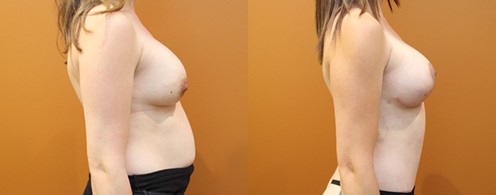 Breast Lift With Implants — 325HP Sub Pect — Side View
